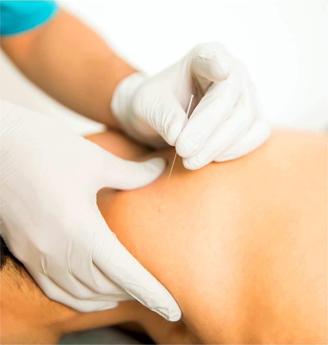 Dry needling can provide pain relief. We offer dry needling for pain management